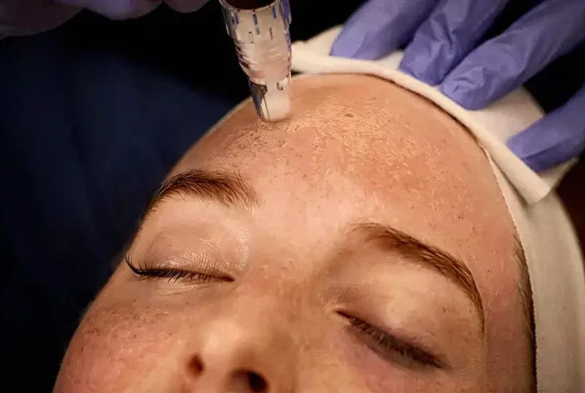 Microneedling with SkinPen & Collagen Induction